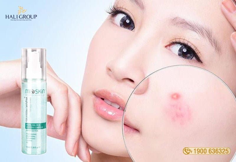 mioskin ngăn ngừa mụn hiệu quả 2